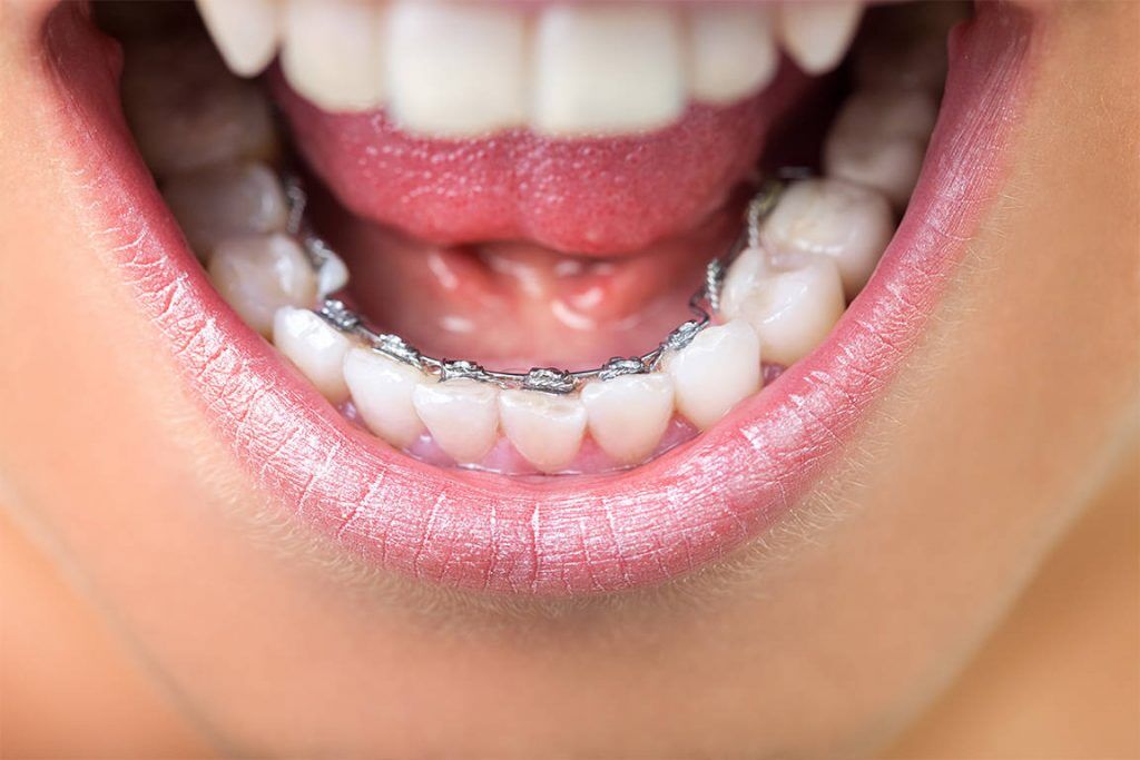 A Comprehensive Guide to How Braces Work: Metal, Invisible, Ceramic, and  Lingual